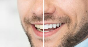 blanqueamiento dental