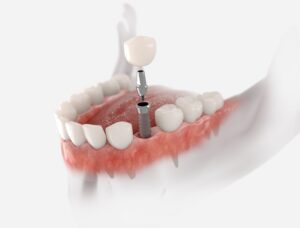 implantes dentales extracción