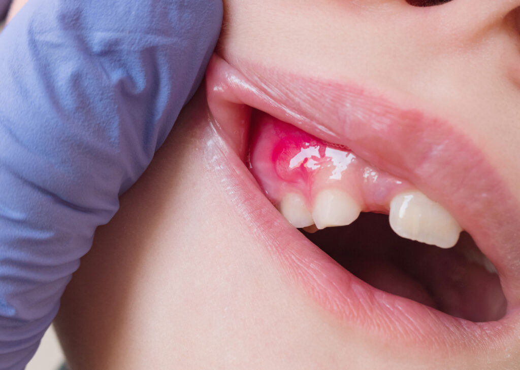 Fístula o flemón dental.