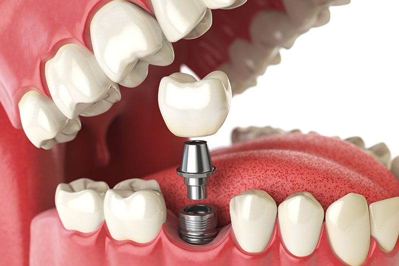 Dentista Madrid, Dentista Ventas, Clínica Dental Madrid, Clínica Dental Ventas.