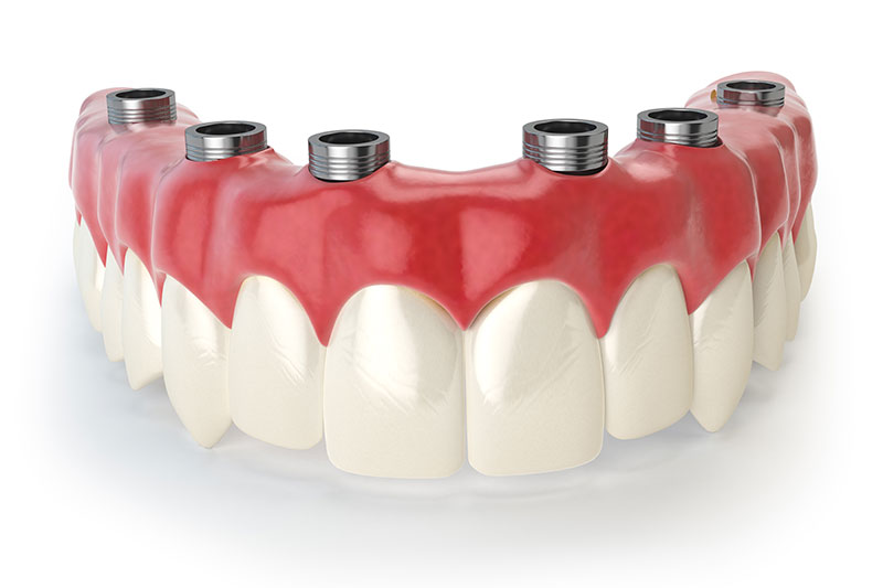 Dentista Madrid, Dentista Ventas, Clínica Dental Madrid, Clínica Dental Ventas.